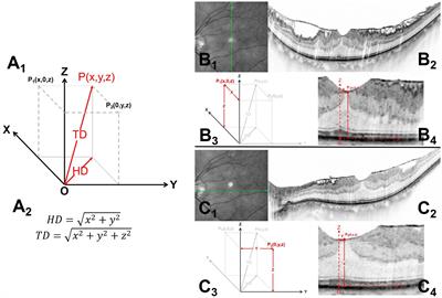 Total and horizontal distances of the foveal stereotaxic displacement can be prognostic indicators for patients with idiopathic epiretinal membrane